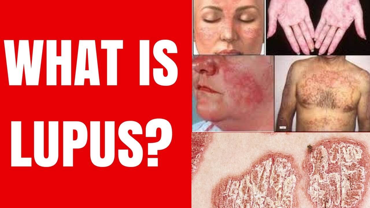 Meaning lupus What is